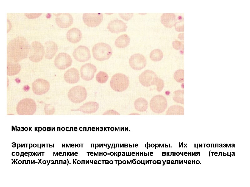 Мазок крови после спленэктомии.  Эритроциты имеют причудливые формы. Их цитоплазма содержит мелкие темно-окрашенные